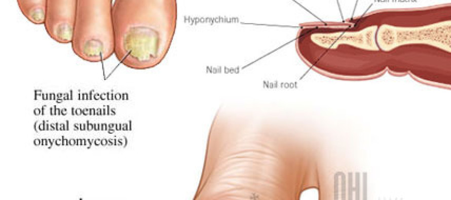 GOOD SOLUTIONS! Best natural cures for toenail fungus